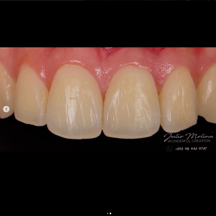 Blanqueamiento dental GUAYAQUIL